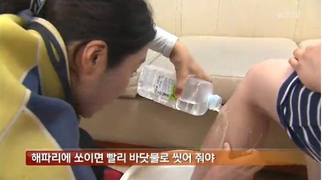 [명동치과 라임나무]해파리에 쏘였을 때 응급처치법을 알아보았습니다 관련 이미지 4