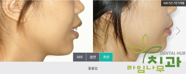 [명동 라임나무치과] 돌출입 교정, 눈에 띄지 않는 콤비교정으로 빠르게! 관련 이미지 2