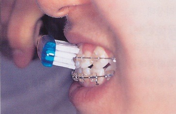 치아교정 중 양치질은 어떻게 하는 것이 좋을까 관련 이미지 3