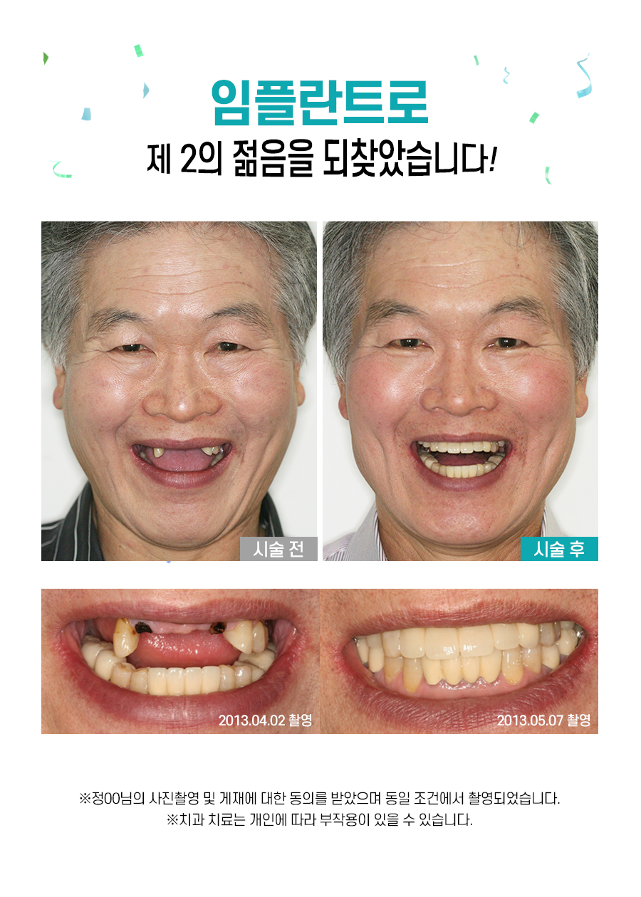 뼈이식 임플란트 어떻게 진행하나요? 관련 이미지 3