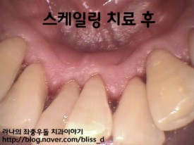 스케일링 건강(의료)보험적용 7월1일부터 시작! 관련 이미지 4