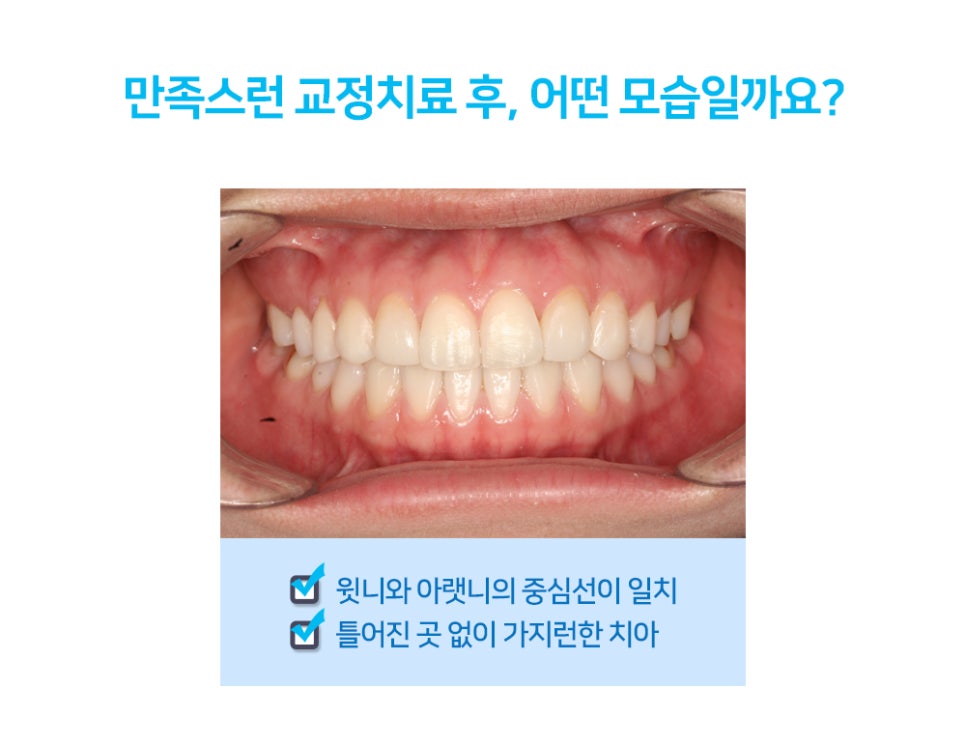 만족스런 치아교정을 위해 살펴봐야 할 것들 관련 이미지 3