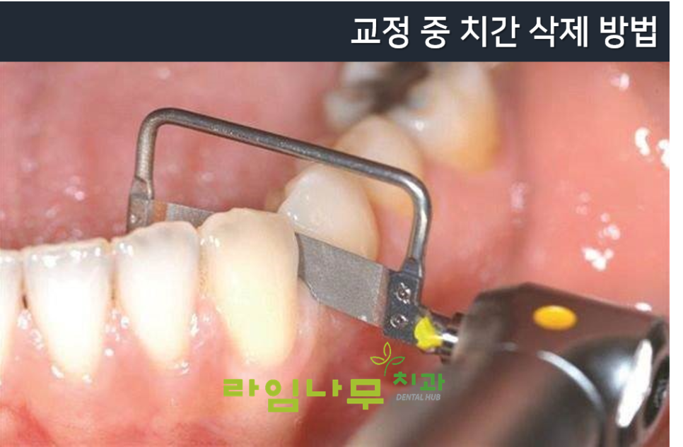 명동치과 잇몸 사이 틈? 치아 공간이 신경 쓰여요. 블랙트라이앵글/라임나무치과 관련 이미지 4