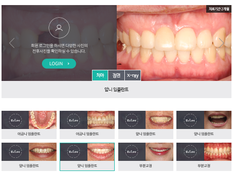 [명동치과] 앞니 임플란트 치과 고르는 방법 관련 이미지 6