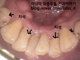 년1회 스케일링 건강보험 적용 확정! 관련 이미지 2