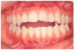 [명동 역삼 라임나무치과] 치아교정, 이런 분들께 꼭 필요해요! 관련 이미지 2