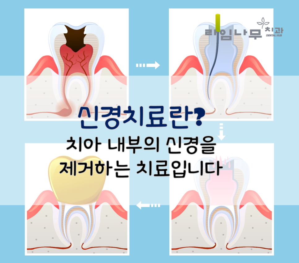 신경치료 해야되는 경우? 명동역치과와 증상 알아봐요 관련 이미지 2