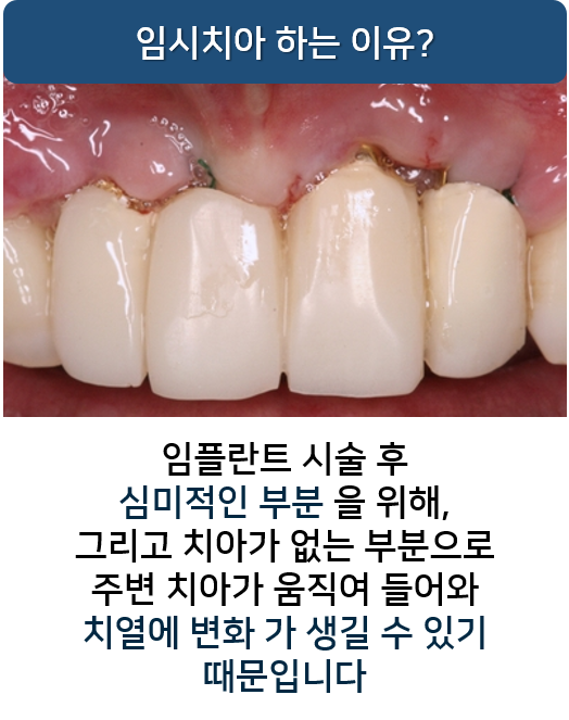 임시치아 빠짐, 빠졌을 때 어떻게? 명동 라임나무치과 관련 이미지 2