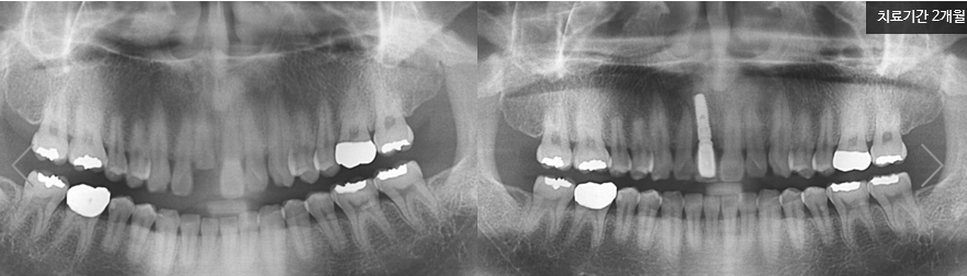 앞니 임플란트 후기 티나지 않아요 명동치과 라임나무 관련 이미지 8
