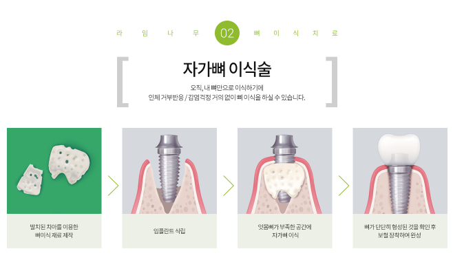 임플란트 기간 얼마나 걸릴까? 임플란트 뼈이식, 임플란트 종류 관련 이미지 3