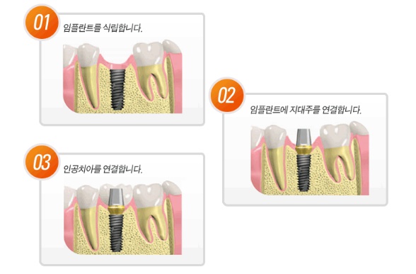 라나의 임플란트 이야기 - 임플란트 치료기간 얼마나 걸려요? 관련 이미지 3