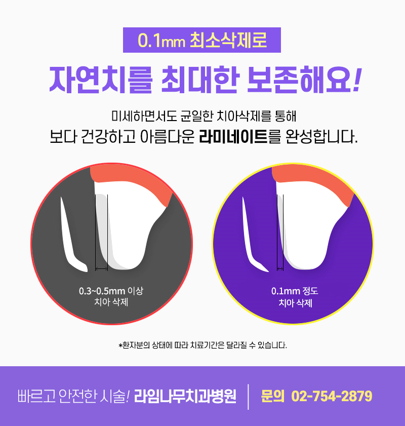 라미네이트 치료, 신중한 결정이 중요합니다 관련 이미지 3