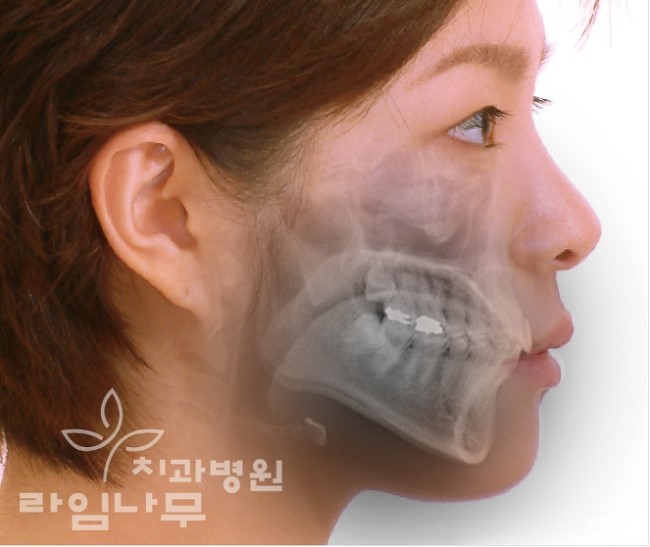 치아교정기간을 결정짓는 요소들 무엇이 있을까? 관련 이미지 2
