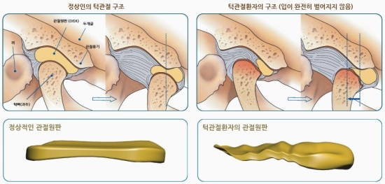 턱관절장애 원인, 어떤 것들이 있으며 치료법은 무엇인지 알아봤어요 관련 이미지 3