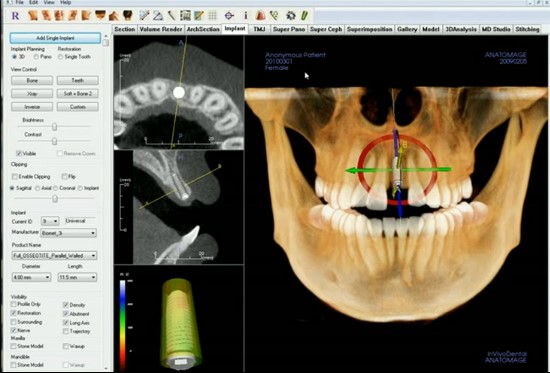 당뇨임플란트 치료방법 관련 이미지 7