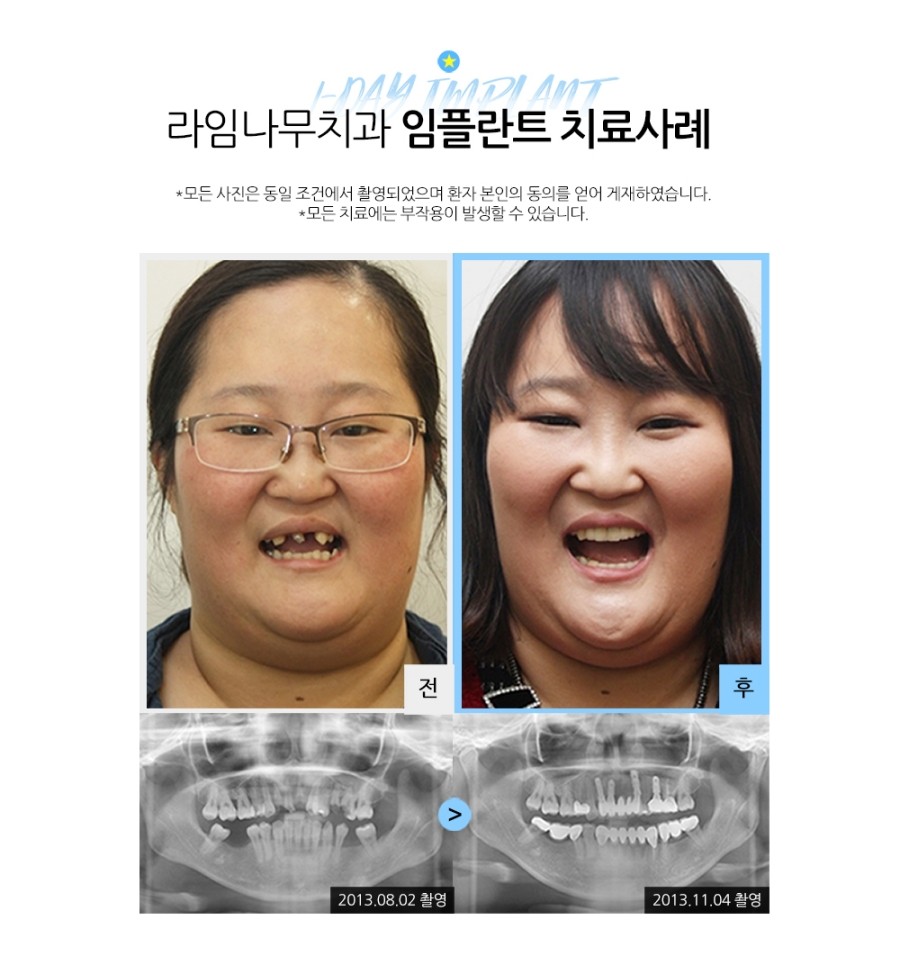 임플란트잘하는곳 라임나무치과병원입니다 관련 이미지 5