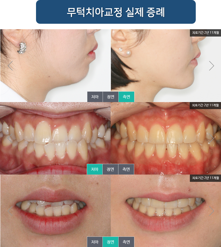 명동치과 라임나무 무턱교정 효과! 증례로 알아봐요 관련 이미지 5