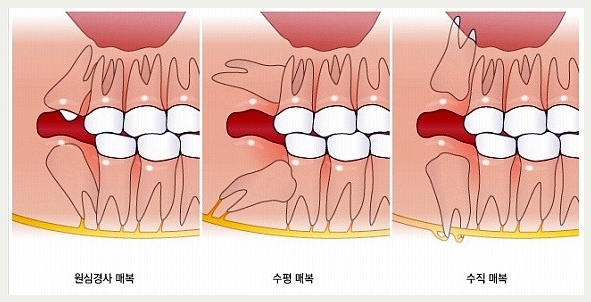 사랑니 수술발치, 어떻게 진행될까요? 관련 이미지 6