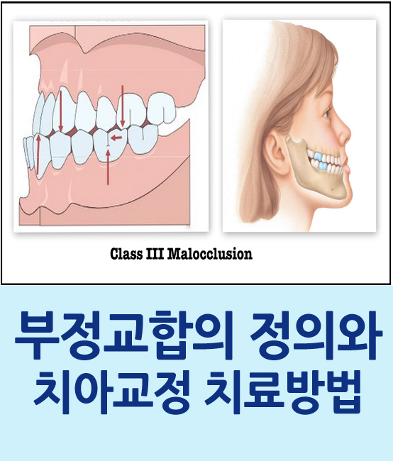 부정교합이란 무엇이며, 어떻게 치료할 수 있을까요 관련 이미지 1