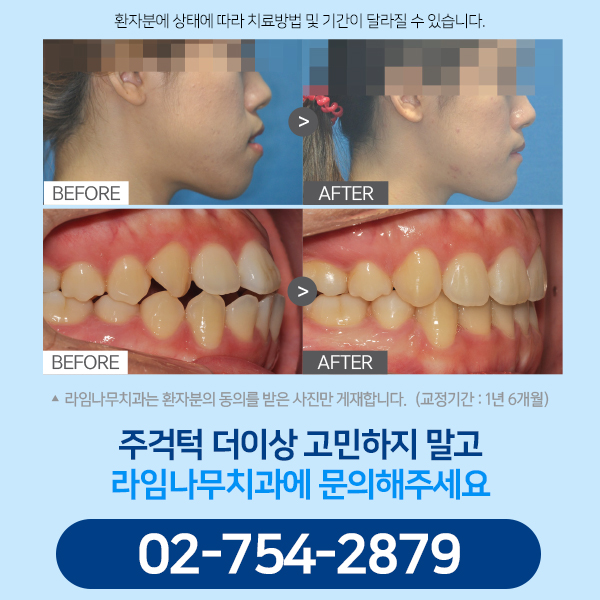 [명동치과] 주걱턱 수술 없이 교정 가능할까요? 라임나무치과 주걱턱 교정 알아보기! 관련 이미지 9