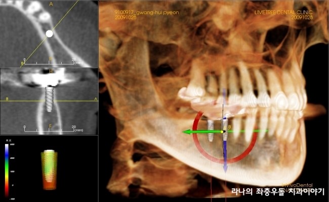 라나의 임플란트 이야기 - 임플란트 시술과정이 궁금해요. 관련 이미지 6