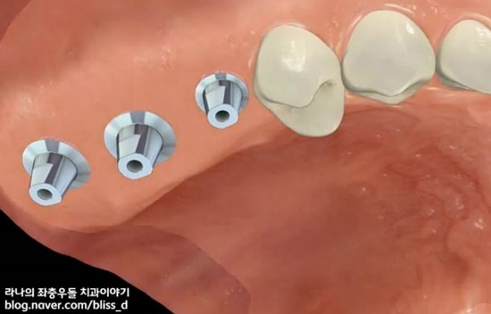 뼈이식 임플란트 시술과정 관련 이미지 6