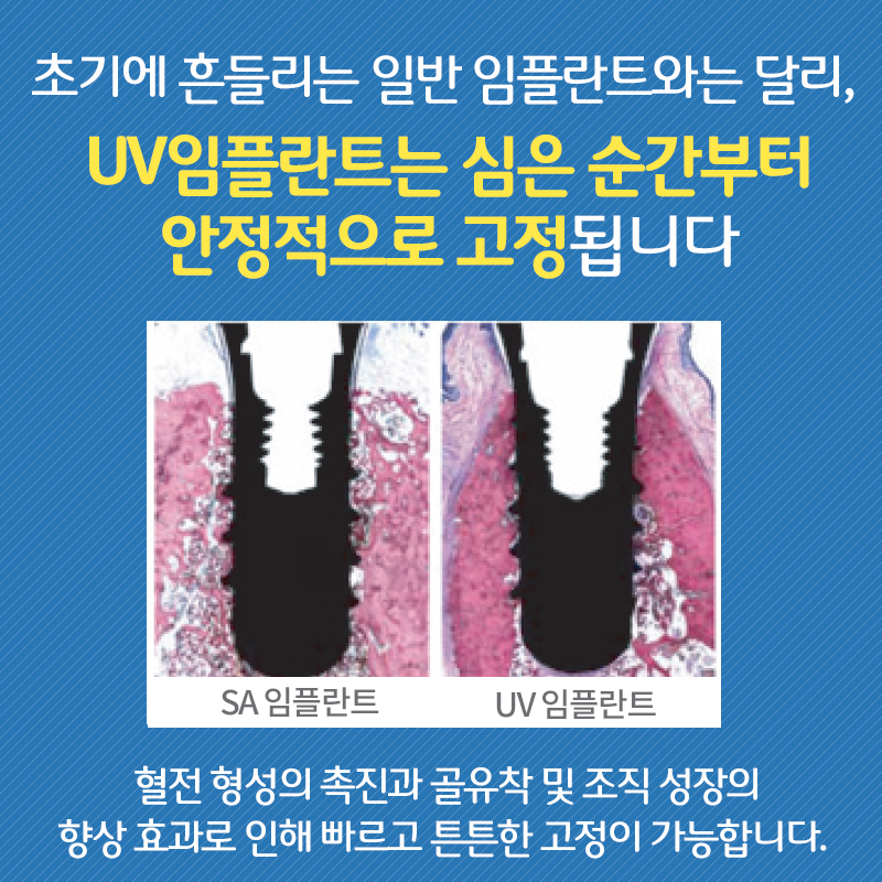 일반임플란트에 비해 안정적인 UV임플란트??? 빠른 골유착으로 바쁜 직장인들에게 딱이네요 관련 이미지 8