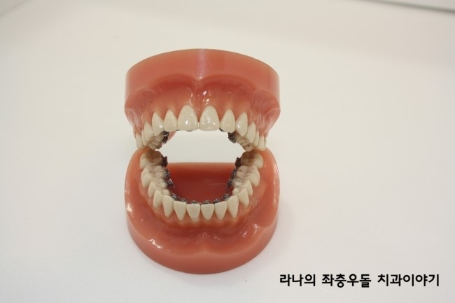 연예인들이 하는 치아교정? 연예인 치아교정 대세를 알아보자 관련 이미지 3