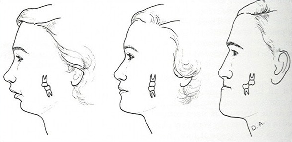 부정교합이란 무엇이며, 어떻게 치료할 수 있을까요 관련 이미지 5