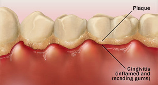 충치의 원인과 치료방법 관련 이미지 3