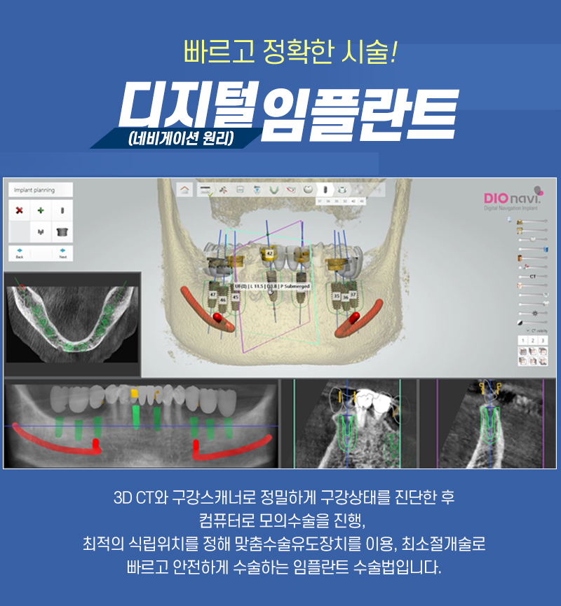 을지로입구치과 라임나무치과에서 임플란트 하세요 관련 이미지 6