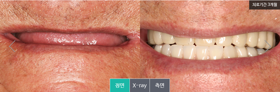 명동치과 만족도 높은 임플란트 틀니 알아보기! 라임나무 관련 이미지 8