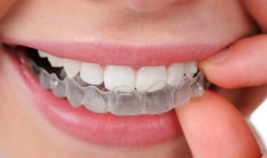 치아교정 종류와 비용 알아보기 관련 이미지 18