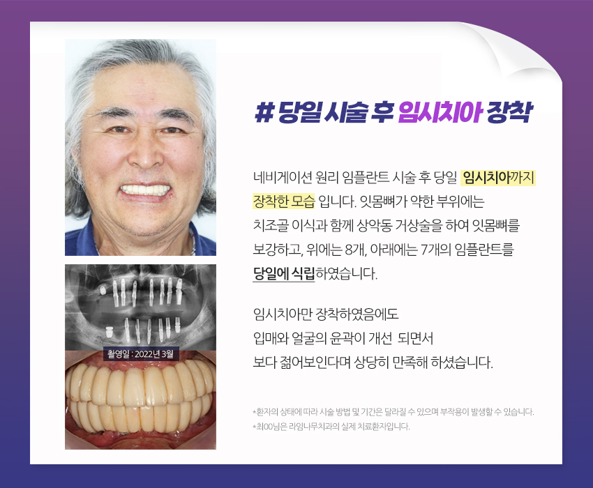 [라임나무치과]네비게이션 원리 임플란트, 실제 사례를 통해 알아봤습니다. 관련 이미지 4