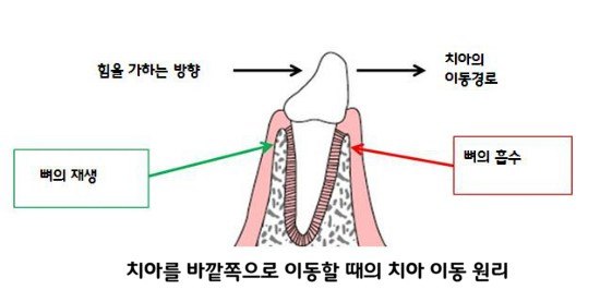 치아교정 한 달에 한번 내원해야 하는 이유? 관련 이미지 4