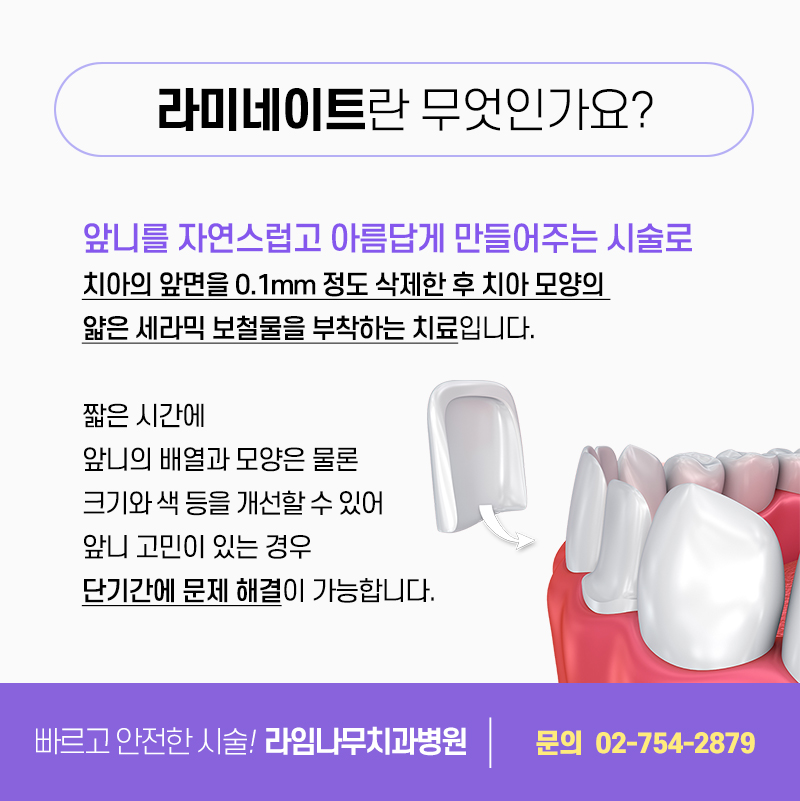 라미네이트 치료, 신중한 결정이 중요합니다 관련 이미지 2