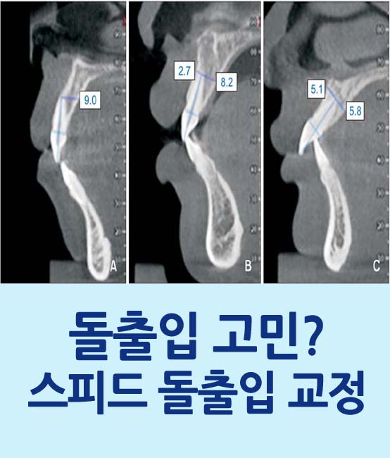 돌출입의 정의와 돌출입 교정에 대한 모든 것을 공개합니다 관련 이미지 1