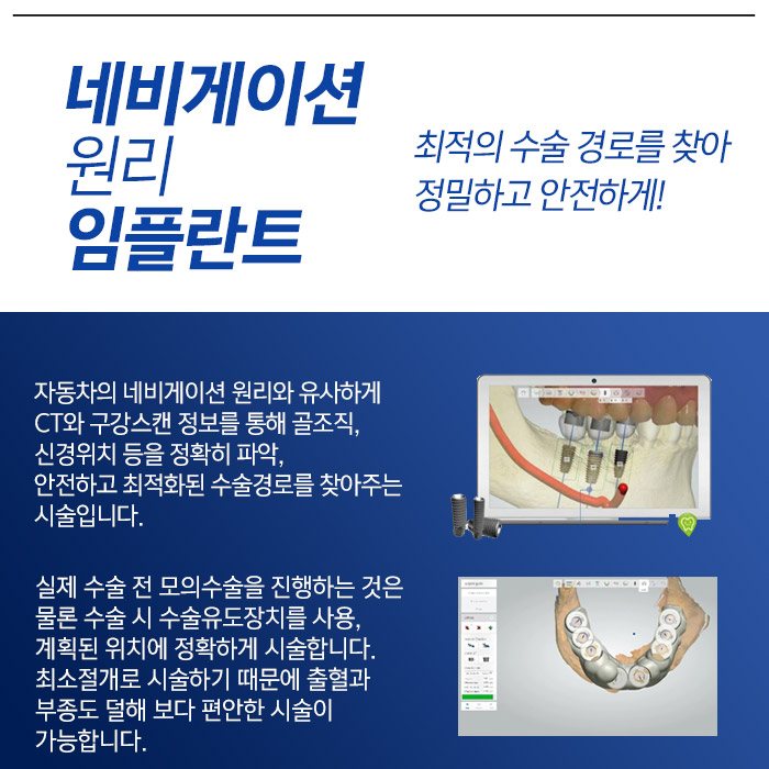 당일임플란트 어떻게 하나요? 명동 라임나무치과 관련 이미지 6