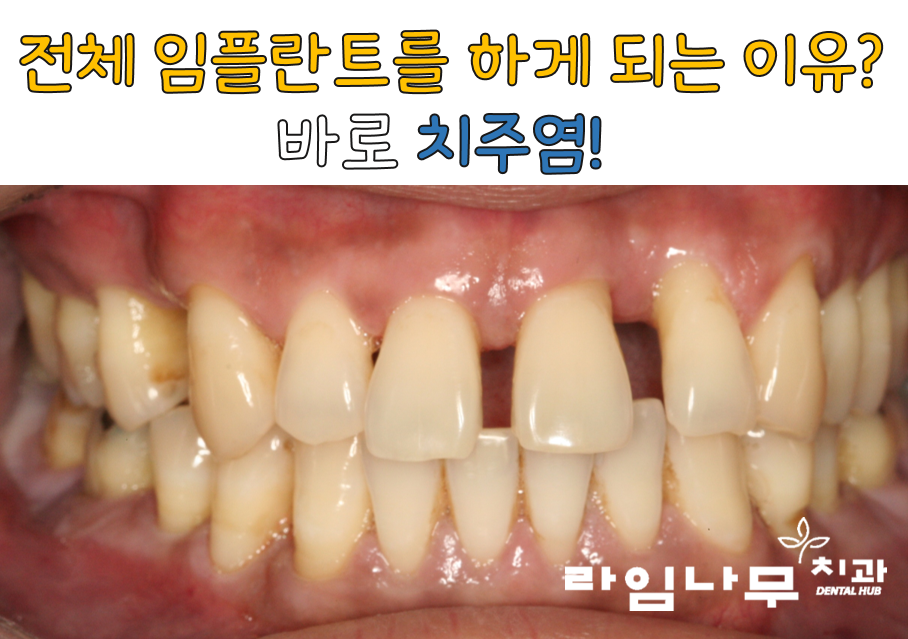 명동치과 전체임플란트 증례! 치주염으로 전체 치아의 기능을 상실한 치아 관련 이미지 2