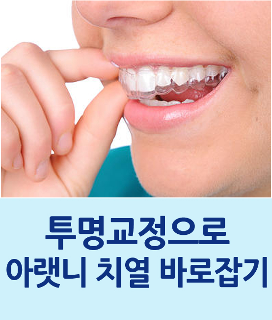 [의료진 교정일기]투명교정으로 아랫니 치열 바로잡기 관련 이미지 1