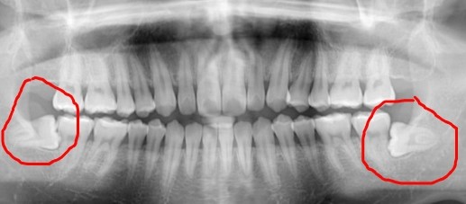 사랑니 발치에 대한 궁금증, 라나가 시원하게 해결해 드립니다 관련 이미지 3