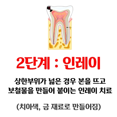 [충치치료종류] 충치치료 언제까지 참으실건가요?? 관련 이미지 6