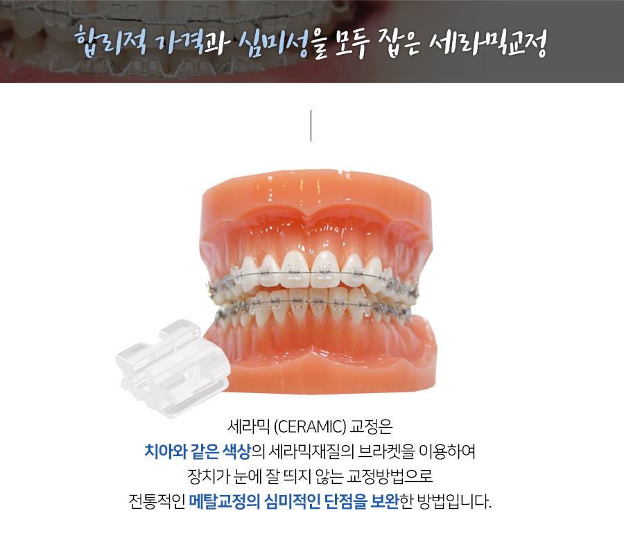 합리적 가격과 심미성을 모두 잡은 세라믹교정 관련 이미지 2