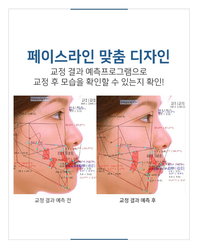 명동치과에서 비발치교정 시작해 보세요 관련 이미지 7