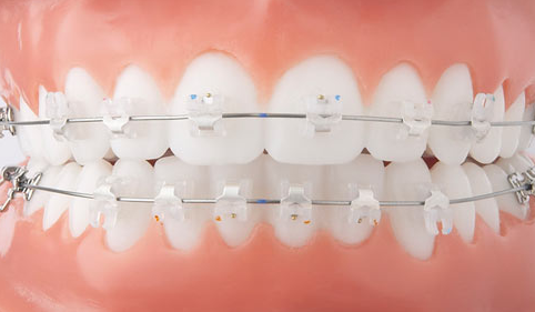 치아교정 종류와 비용 알아보기 관련 이미지 15