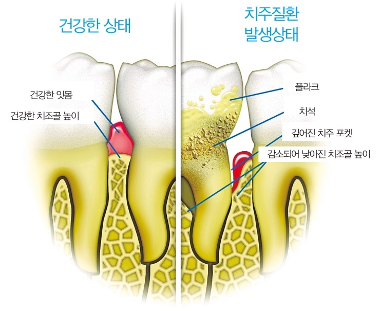 자연치아를 살리는 합리적인 방법, 잇몸치료부터 하세요~ 관련 이미지 7