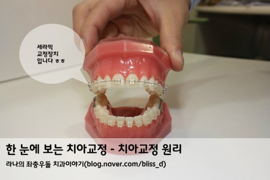 한 눈에 보는 치아교정 - 치아교정 원리 관련 이미지 1