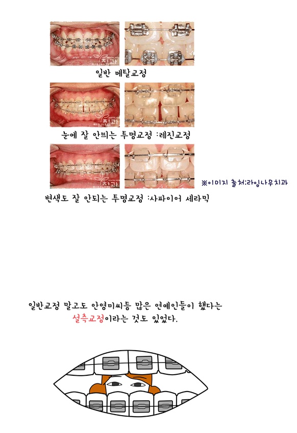 강남역 교정치과 선택시 주의사항 관련 이미지 6