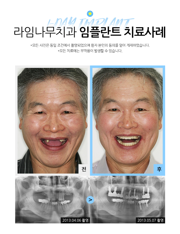 무치악임플란트 알아보고 계신다면? 라임나무치과에서 상담 받으세요! 관련 이미지 7