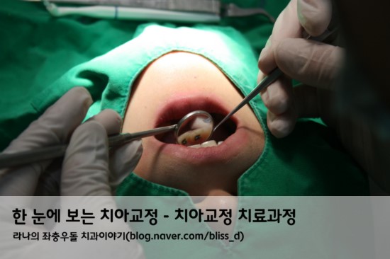 한 눈에 보는 치아교정 - 치아교정 치료과정 관련 이미지 1